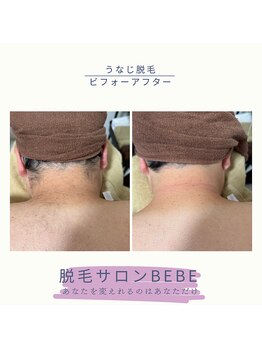 ベベ(Bebe)/うなじ脱毛♪