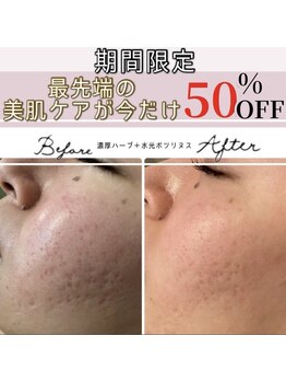 アリュール 倉敷(ALLURE)の写真/《最強肌質改善メニューが今だけ50%OFF》お好みの肌質改善メニュー＋水光ボツリヌスの組み合わせで効果絶大