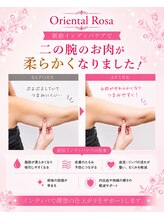 オリエンタルローザ 表参道(Oriental Rosa)/術前インディバケア大人気です！