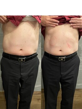 長寿鍼灸院 長寿整骨院/EMS＜お腹集中コース＞