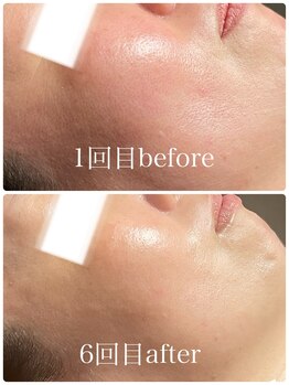 イーストモア(EAST MOIS)/W光フェイシャル6回継続した結果
