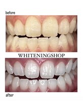 ホワイトニングショップ 明石大久保店/【BeforeAfter】