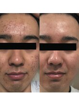 クロム(CHROME)/水光ピーリング　つや玉