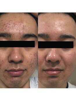 クロム(CHROME)/水光ピーリング つや玉