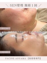 ファシネアオヤマ(FACINE AOYAMA)/SEN管理一回での効果