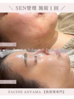ファシネアオヤマ(FACINE AOYAMA)/SEN管理一回での効果