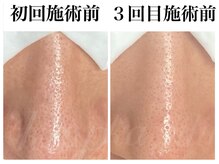 カピリナ(ka pilina)/長年毛穴にお悩みの方！