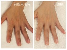 キレイテ 福岡天神店/50代/8回目【大名ハンドケア】