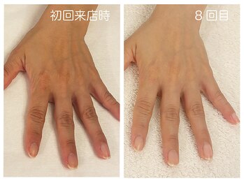 キレイテ 福岡天神店/50代/8回目【大名ハンドケア】