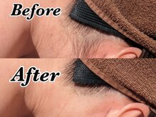 ディオーネ 西船橋駅前店(Dione)/うなじ・襟足脱毛◇Before After