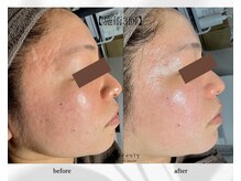 アン ビューティー(ann beauty)/施術3回【症例写真】30代