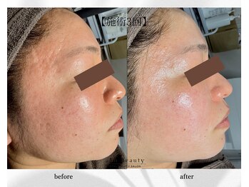 アン ビューティー(ann beauty)/施術3回【症例写真】30代