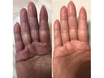 ビーダブリュー(BW...)/しつこい手荒れケアも、プラズマ