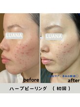 ルアナ 北谷店/ハーブピーリング 《沖縄/北谷》