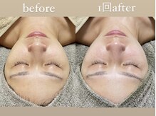 クレヴィー(Creviy)/陶肌トリートメント《Special》