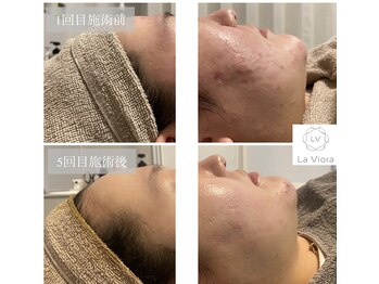 ラヴィオーラ 福島野田店(La Viora)/ダイヤモンドハーブピーリング