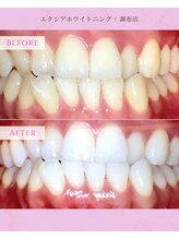 エクシアホワイトニング 調布店/30代男性会員様/奥様も大絶賛！