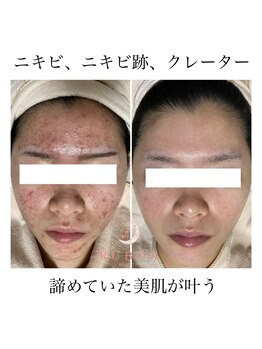 【美肌脱毛/シミケア/ニキビ肌改善エステ/ハーブピーリング】RUBON宮崎店/ニキビケア症例