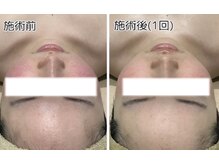 エヌ(enu)/ハーブピーリング/フェイシャル