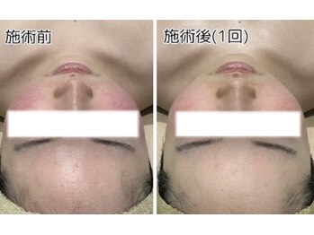 エヌ(enu)/ハーブピーリング/フェイシャル