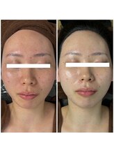 ルリエベル(Relier Belle)/ REVIハーブピーリング