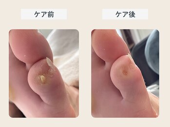 ルポ 伊勢/タコ・ウオノメのケア
