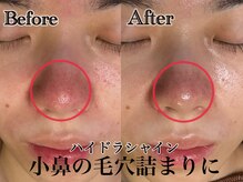 アンドエス 六本木(and S.)/気になるいちご鼻に！毛穴洗浄