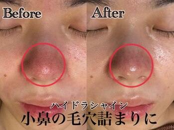 アンドエス 六本木(and S.)/気になるいちご鼻に！毛穴洗浄