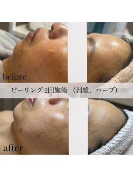 シェリー(SHELLY)の写真/【ニキビ後のお肌に、美白ケア】お肌を土台から整えるハーブピーリング