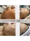 シェリー(SHELLY)の写真/【ニキビ後のお肌に、美白ケア】お肌を土台から整えるハーブピーリング