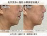 【毛穴&二重あごに◎】40代からの毛穴ケア◎毛穴洗浄+脂肪分解美容液導入