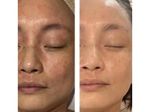 アドビューティ(Add Beauty)/何をしても変わらなかった肌質へ