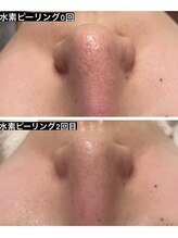 ユニセックスサロン アンシェル(UNISEXSALON UNCHEL)/【ハイドラフェイシャル】