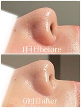 イーストモア(EAST MOIS)/W光フェイシャル6回継続した結果