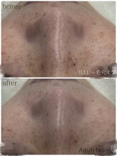 アミリービューティー ひたち野うしく店(Amily beauty)/イラストリアス＋オプハイドラ