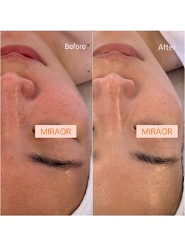 ミラー(MIRAOR)/輪郭リフトクリスティーナエステ