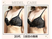 メデル 北千住店/バストアップ＊育乳症例