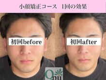 キュープ 表参道店(Qpu)/ 小顔矯正回コース1回の変化