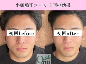 キュープ 表参道店(Qpu)/ 小顔矯正回コース1回の変化