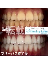ホワイトニングサロン 福岡天神店/ホワイトニング