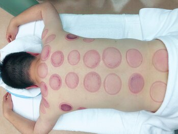 たくみ整体院/【竹吸玉】施術における残色色体