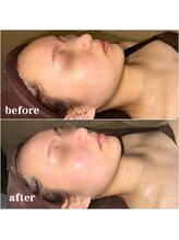 ビューティースタイリング 自由が丘店(beauty styling)/【話題の再生ピーリング】