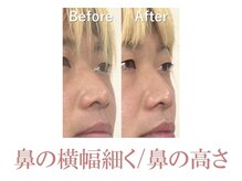 ラプリ 新宿店(Raplit)/隆鼻＋輪郭矯正40分10回