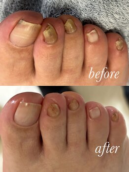 リゼラアンドコー 柏原店/肥厚爪