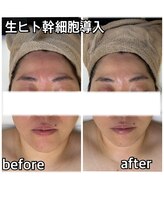 ルネ(Rune)/ヒト幹導入ビフォーアフター