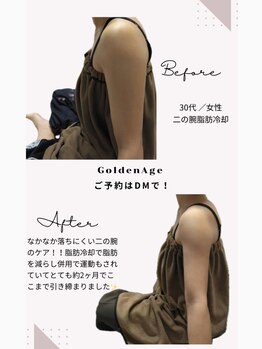 ゴールデンエイジ(Golden Age)/二の腕脂肪冷却【痩身】