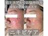 ずっと肌トラブルでお悩みの方へ！本気のニキビケア肌改善エステ