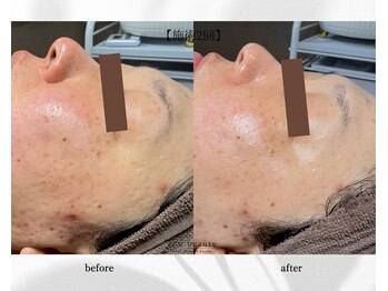 アン ビューティー(ann beauty)/施術2回【症例写真】30代