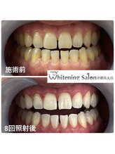 ホワイトニングサロン 京都烏丸店/ホワイトニング施術例