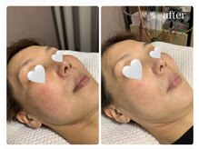 ナチュライズ(NatuRise)/くすみ、シミ改善